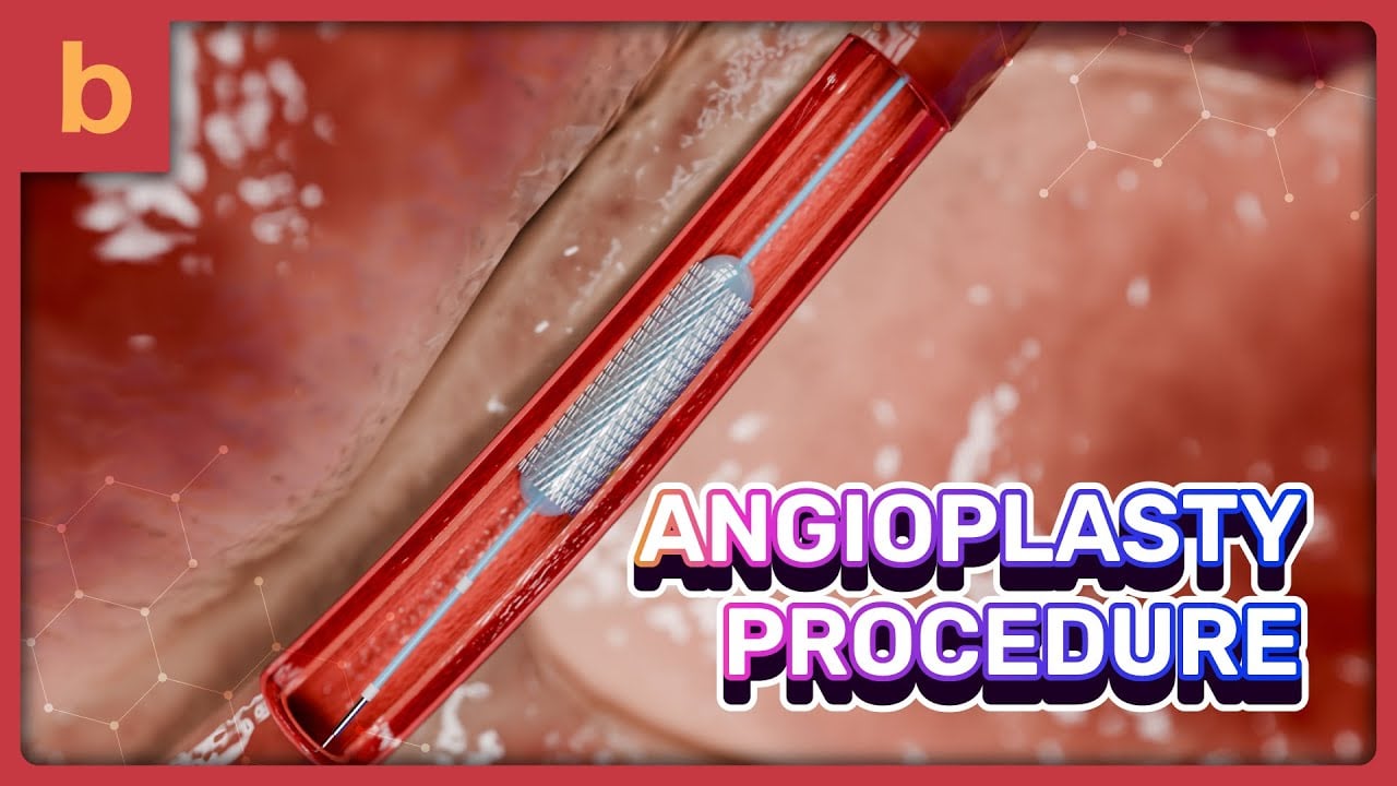 How Angioplasty Works - 3D Animated Explainer